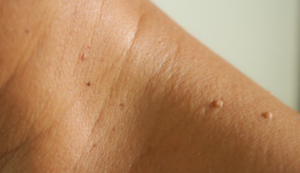 Skin Tag Example